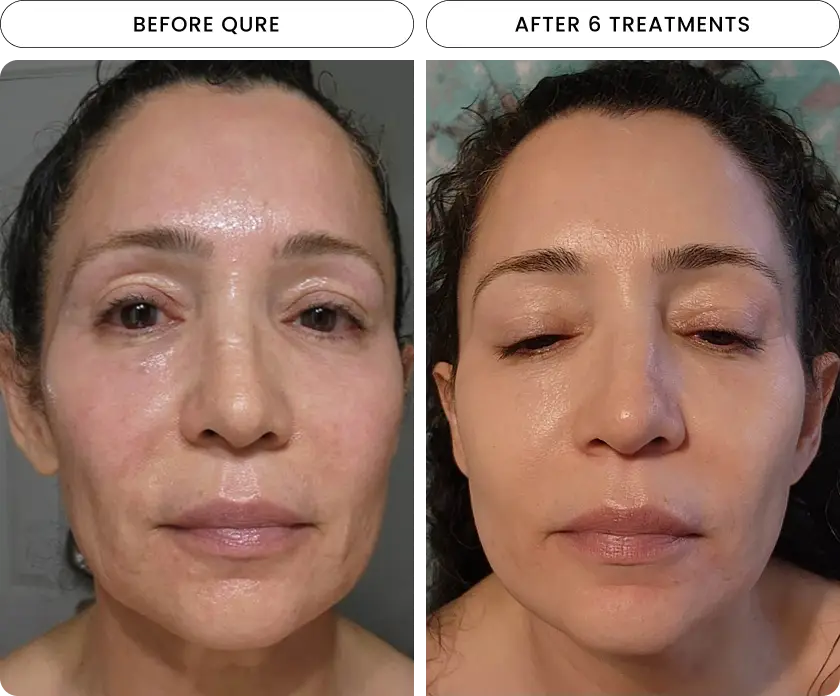 Micro-Infusion 6 Month Bundle (For Dark Spots) - Image 3